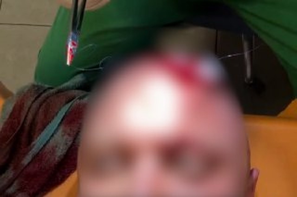    Мужчине пробили лоб травматом. Фото: скриншот видео