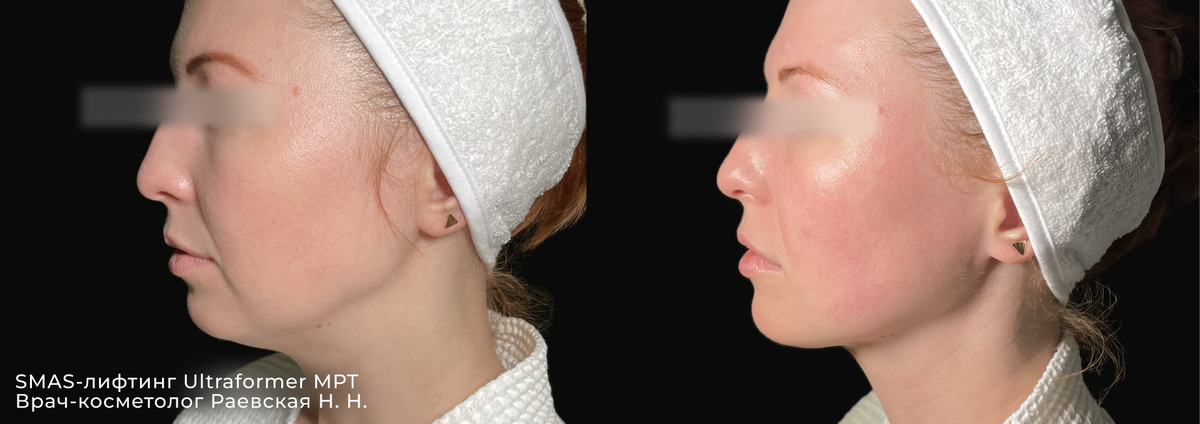 Фото ДО и ПОСЛЕ SMAS лифтинг Ultraformer MPT | Клиника косметологии GEN87 в Москве