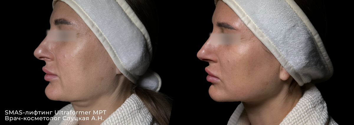 Фото ДО и ПОСЛЕ SMAS лифтинг Ultraformer MPT | Клиника косметологии GEN87 в Москве
