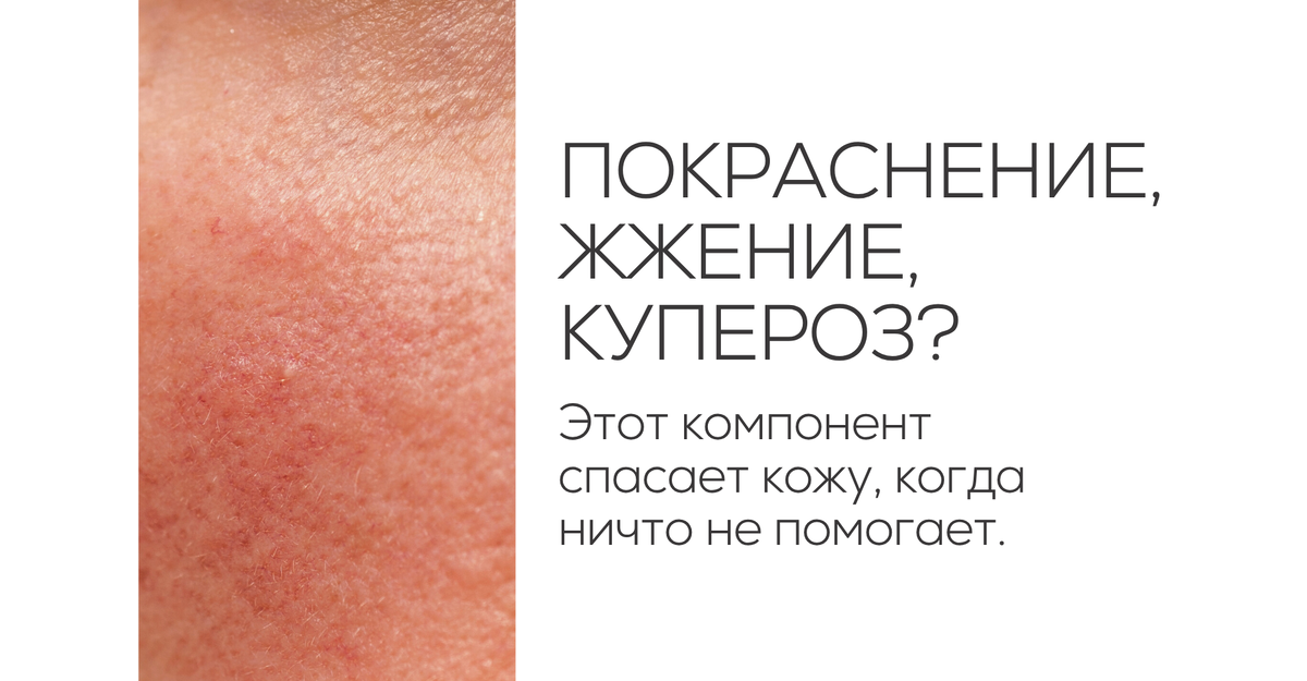 Покраснение, жжение, купероз? Этот компонент спасает кожу, когда ничто не помогает. 