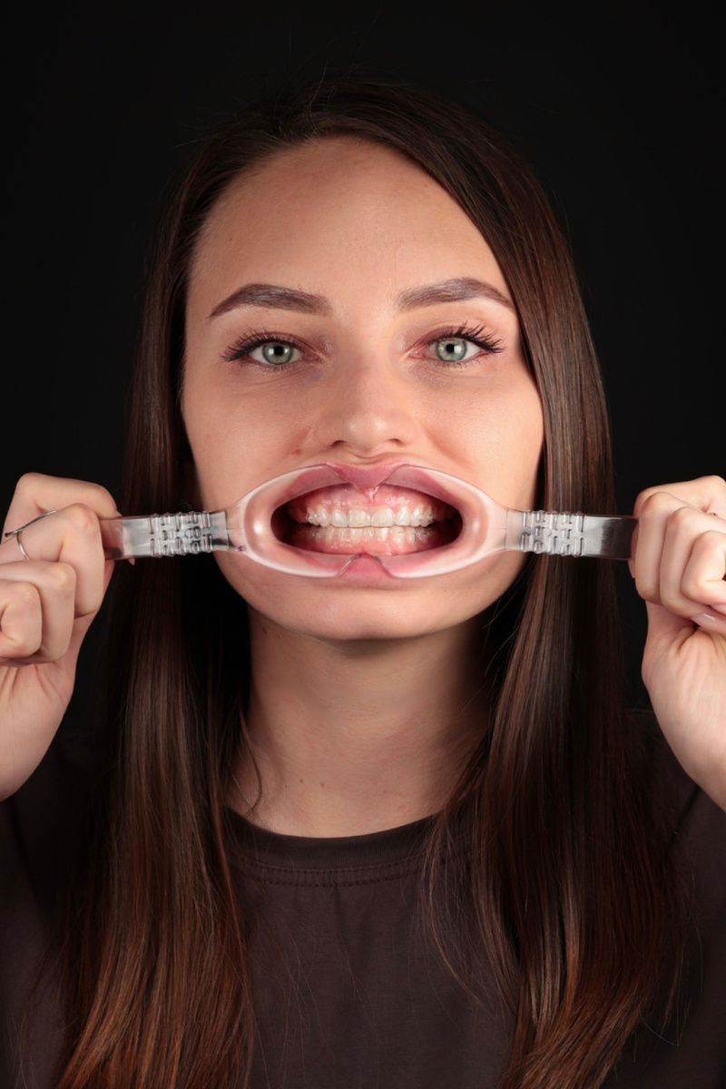 Я в элайнерах