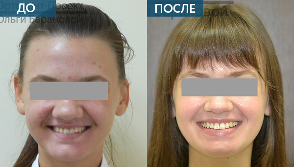 Глубокий прикус до и после
