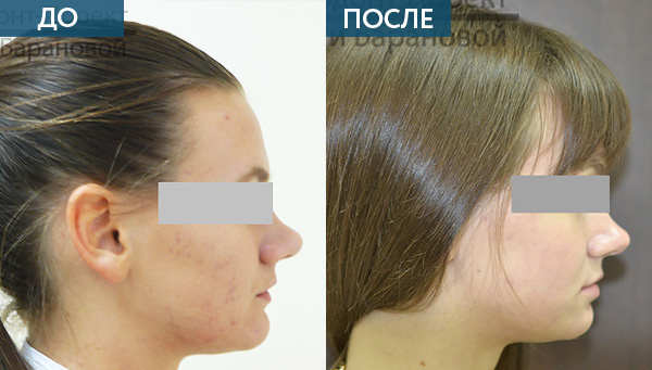 Глубокий прикус,  лицо пациента сбоку