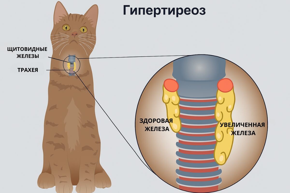 Гипертиреоз