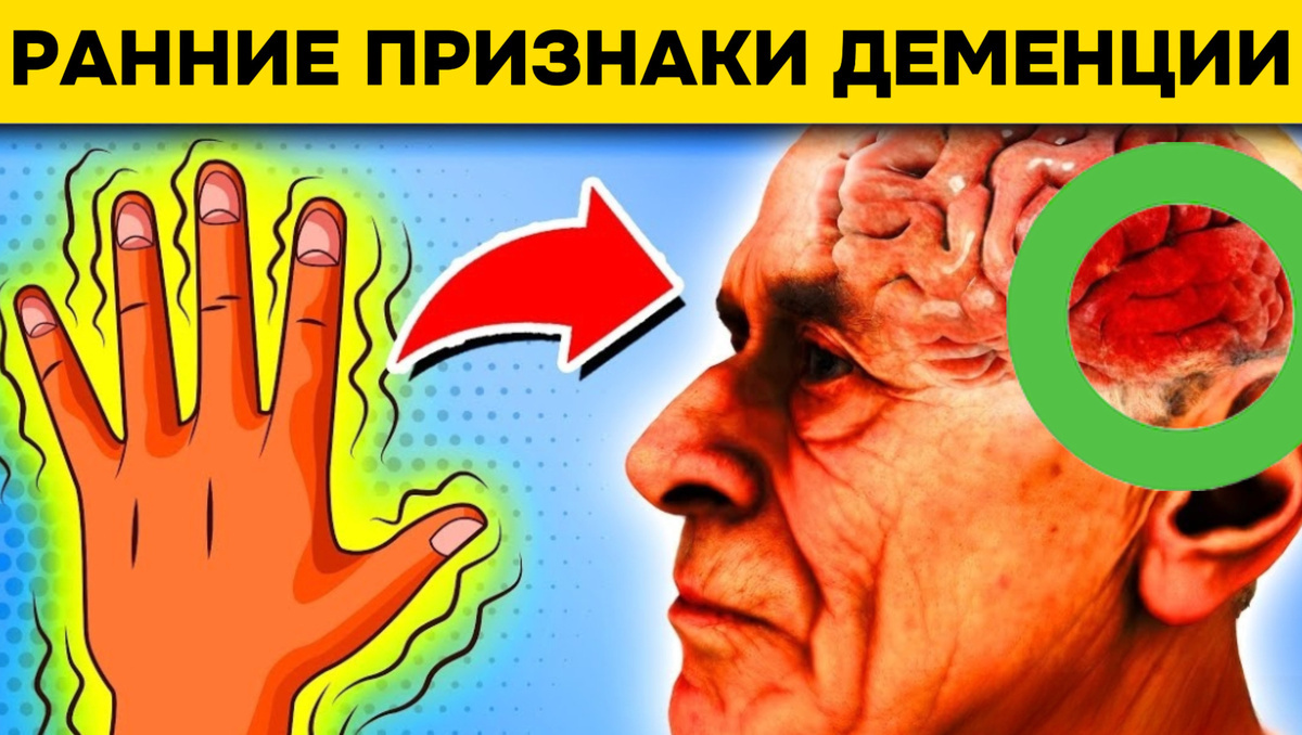 Как Понять, Что Началась Деменция: Ранние Признаки, На Которые Стоит Обратить Внимание