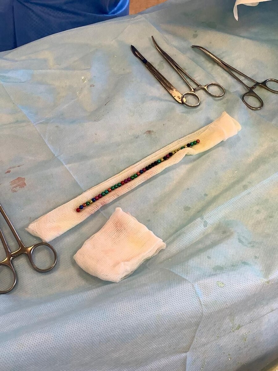    Барнаульские врачи извлекли из ребенка больше 50 магнитных шариков. Источник: Детская городская клиническая больница №7