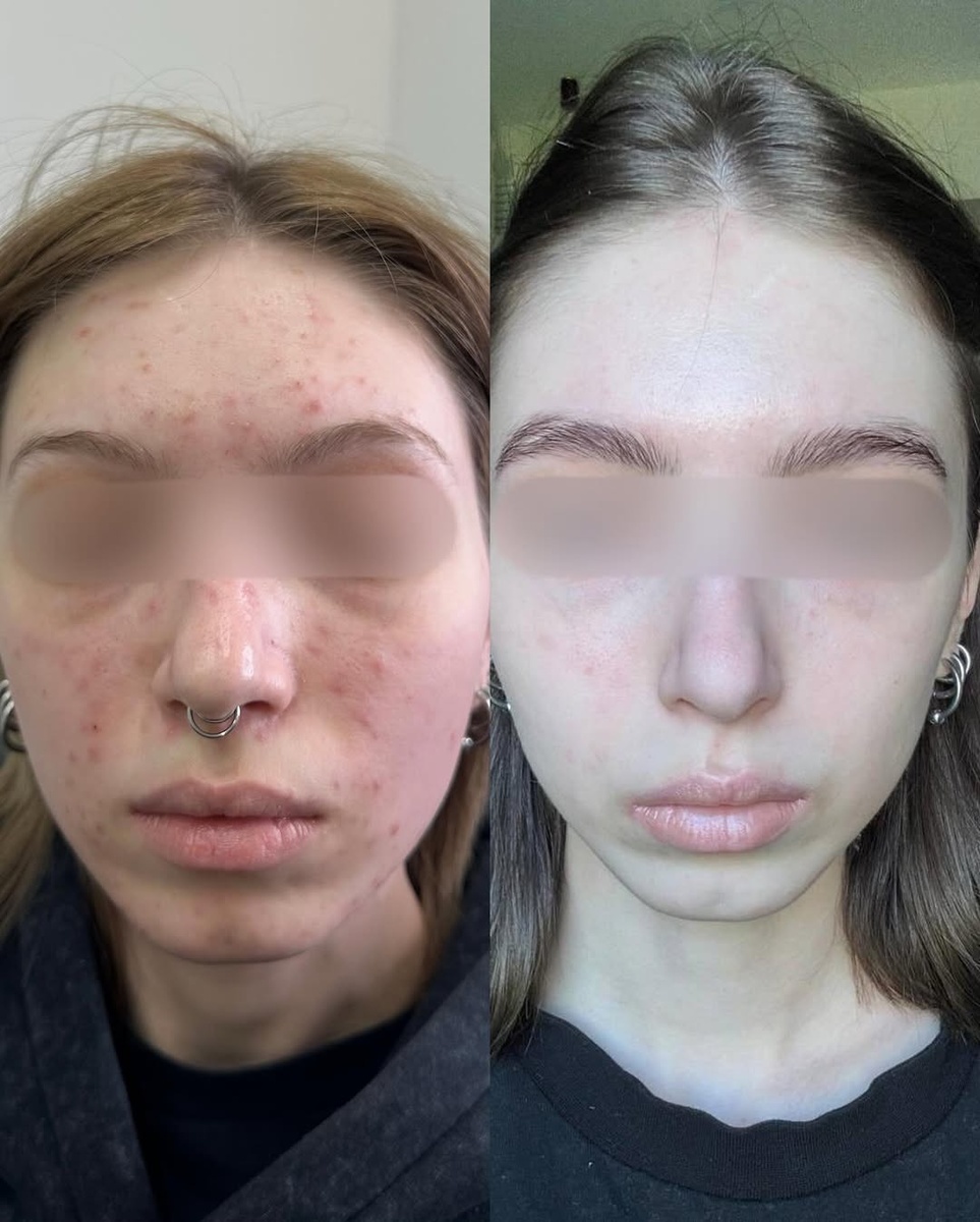 Лечение акне