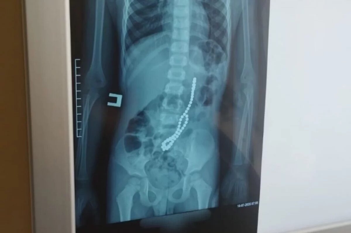    Магниты соединились в кишечнике в цепочку.