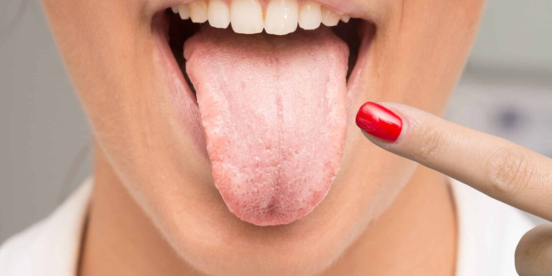 Как выглядит рак на языке. И возможно ли такое?