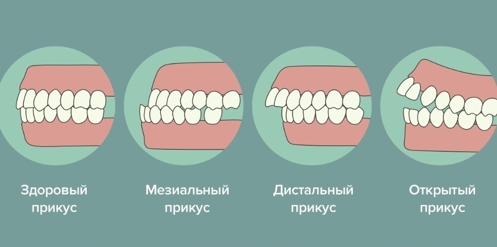 Здоровый прикус и виды нарушения прикуса