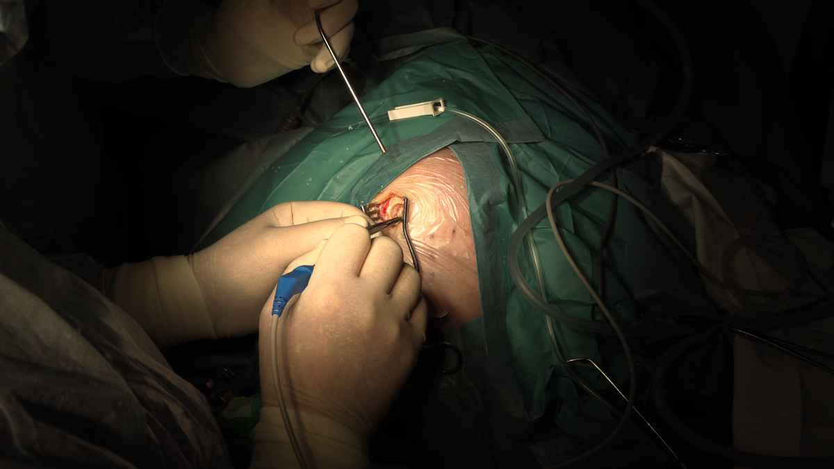 Вариант толстой кости у пациента. Проводится послойное рассечение и коагуляция тканей