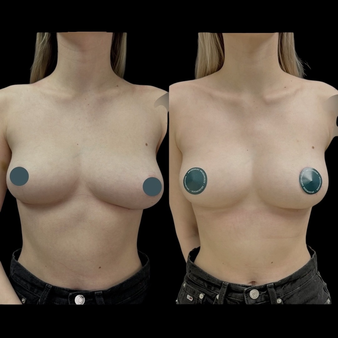 Результат переареолярной подтяжки левой груди