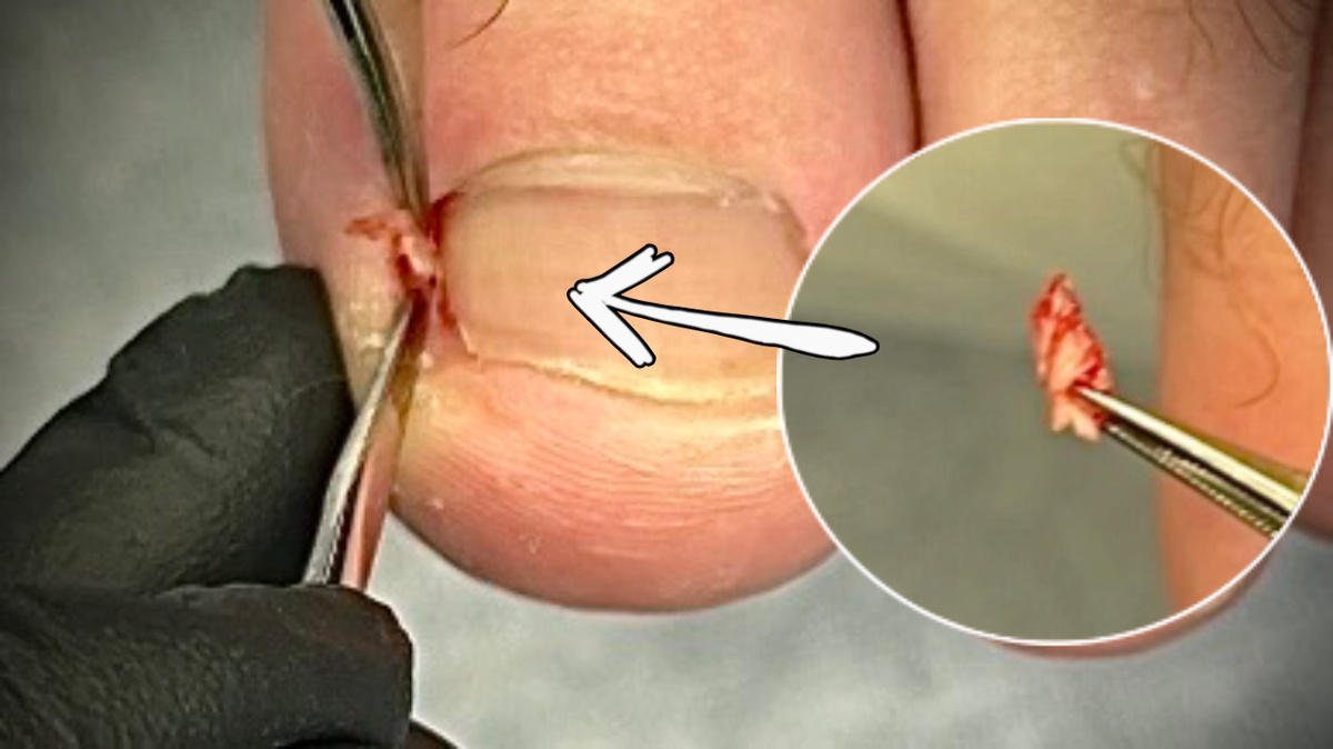 Успех зависит от правильного извлечения вросшего фрагмента