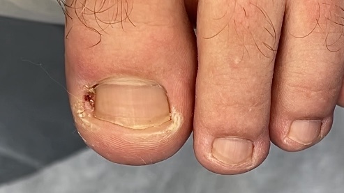 Расположение гнойного очага показывает в каком месте точка врастания. 