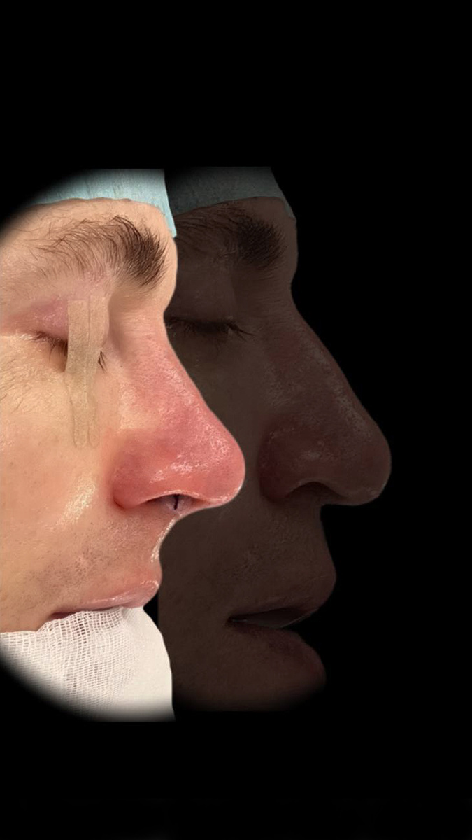 Пластика носа, результат с операционного стола