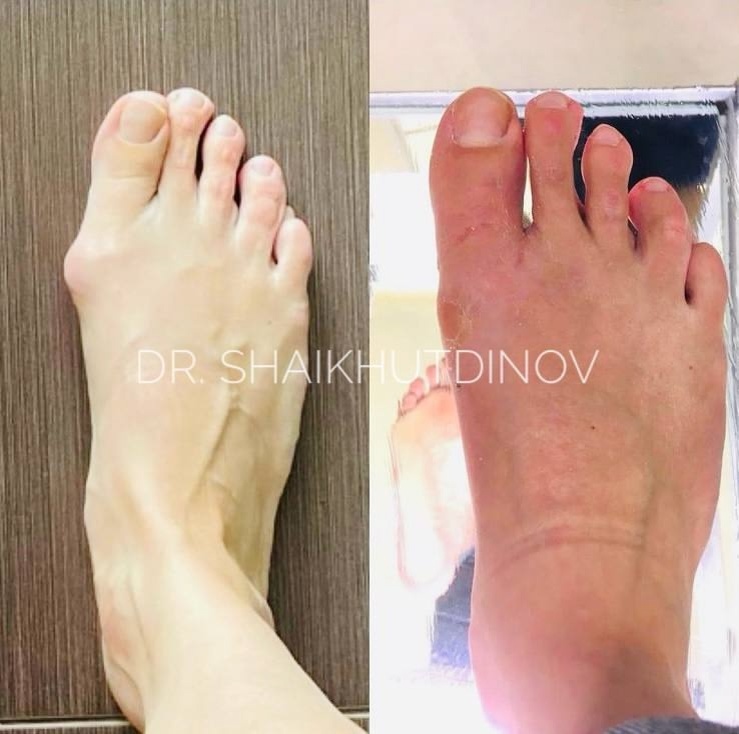 ДО и ПОСЛЕ коррекции миниинвазивной техникой