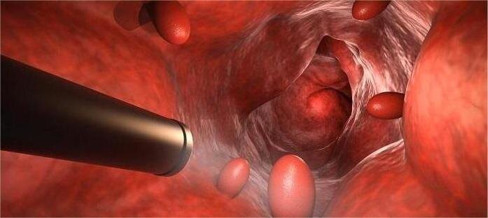Некоторые полипы могут со временем перерождаться в злокачественные опухоли