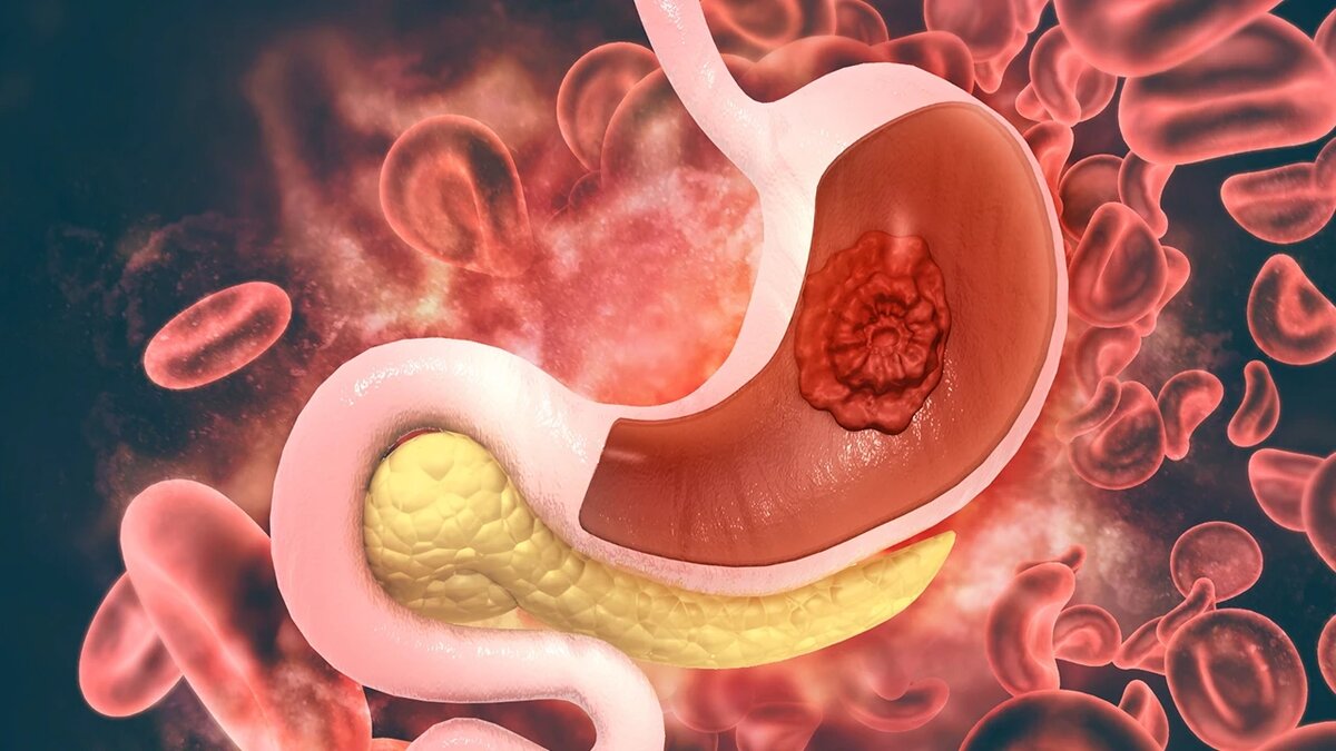 Первые симптомы рака желудка: Не пропусти