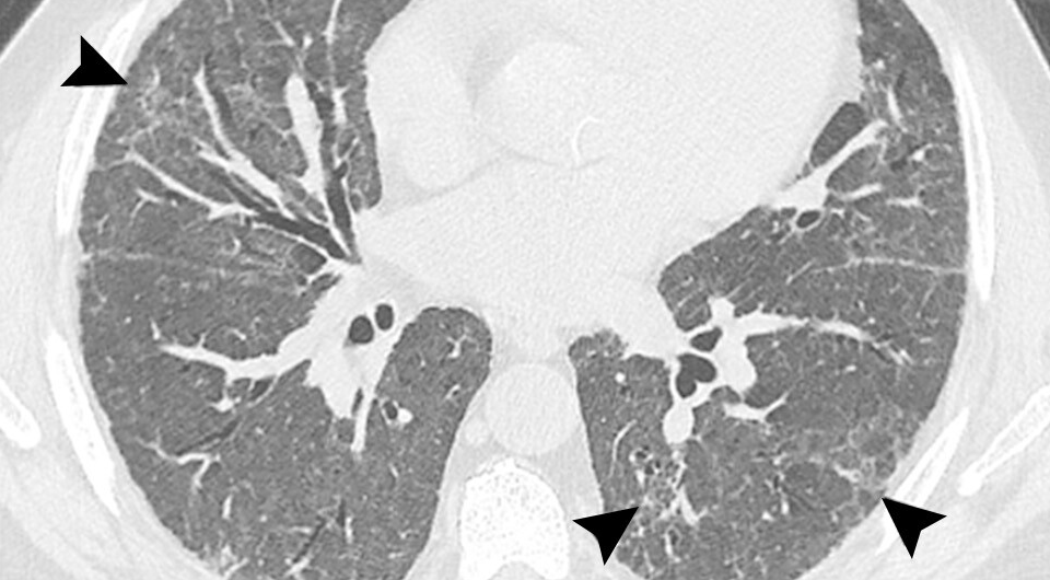   Yoon et. al / Radiology, 2025