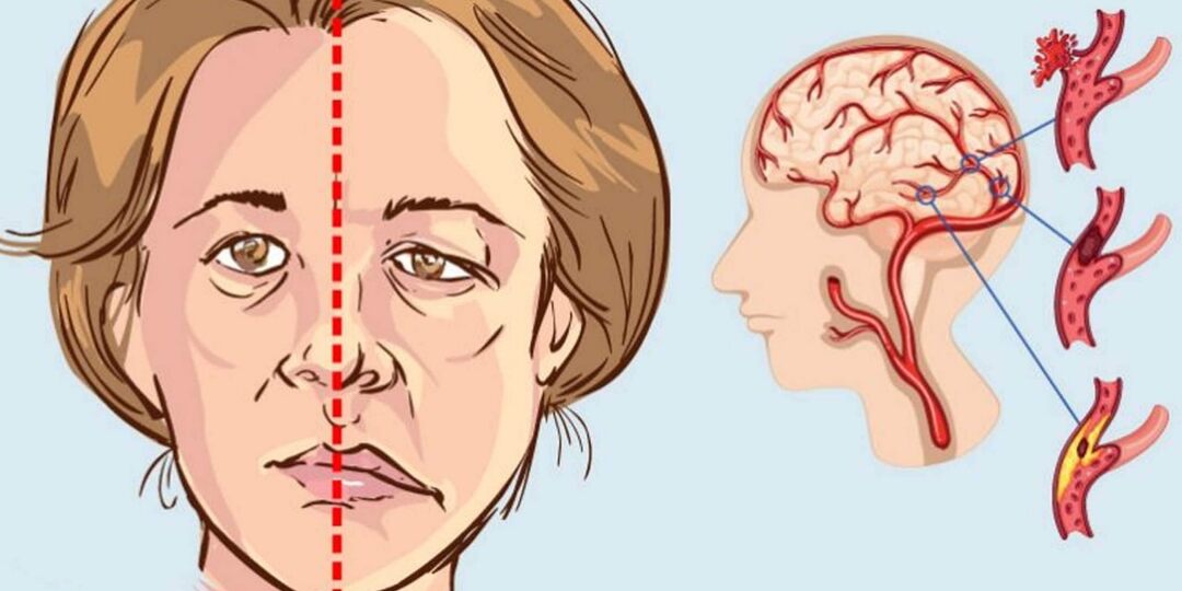 Инсульт Без Боли: Молчаливые Симптомы — Интервью с Неврологом, Доктором Сергеем Грозовым
