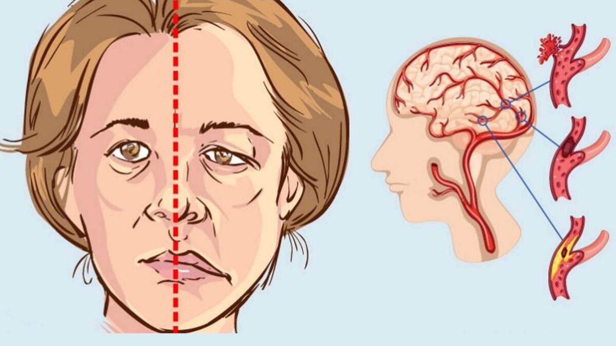 Инсульт Без Боли: Молчаливые Симптомы — Интервью с Неврологом, Доктором Сергеем Грозовым