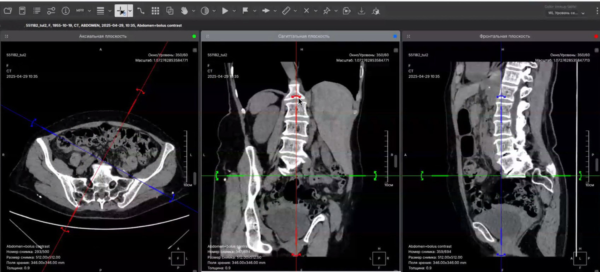 Просмотр изображение в MPR-режиме. Модификация под различными углами в трех плоскостях