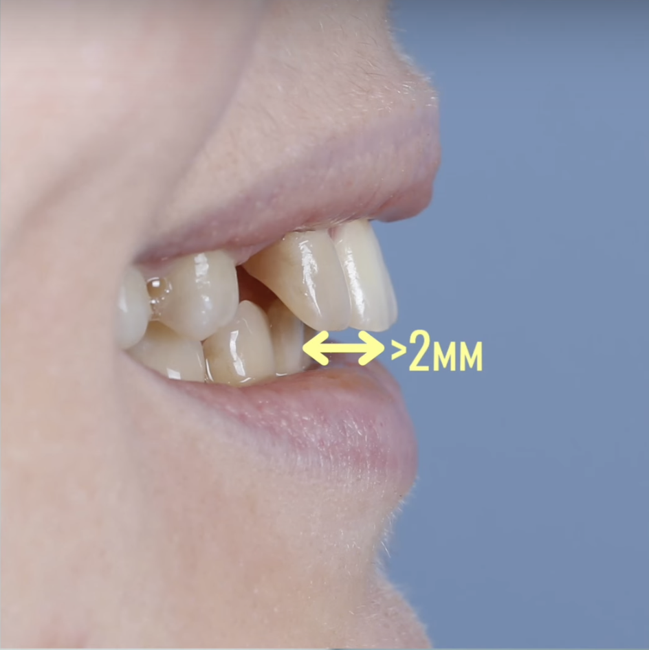 Резцы не контактируют друг с другом