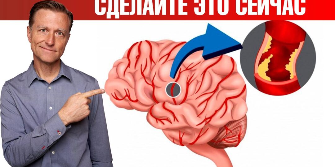 Как не пропустить микроинсульт: Важные признаки и действия