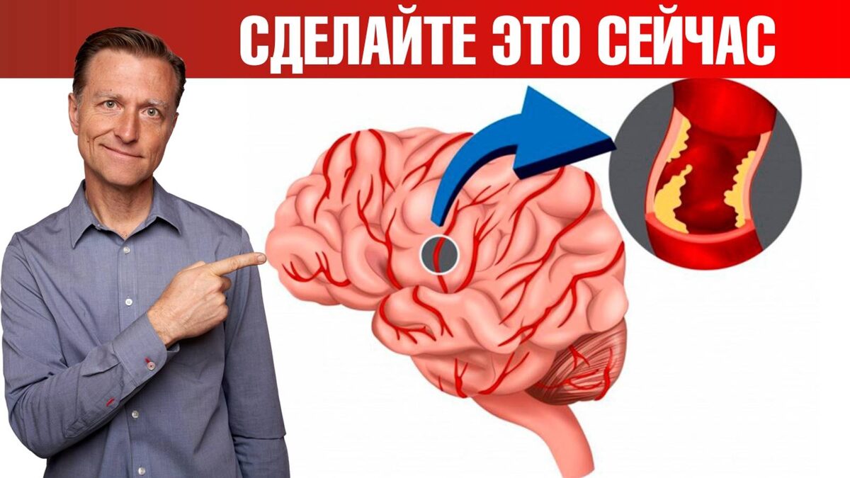 Как не пропустить микроинсульт: Важные признаки и действия
