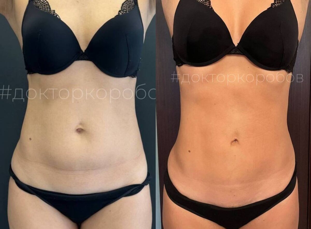 Ушивание диастаза и пупочной грыжи авторским методом через пупочный доступ; липосакция живота. Результат через 6 месяцев после операции.