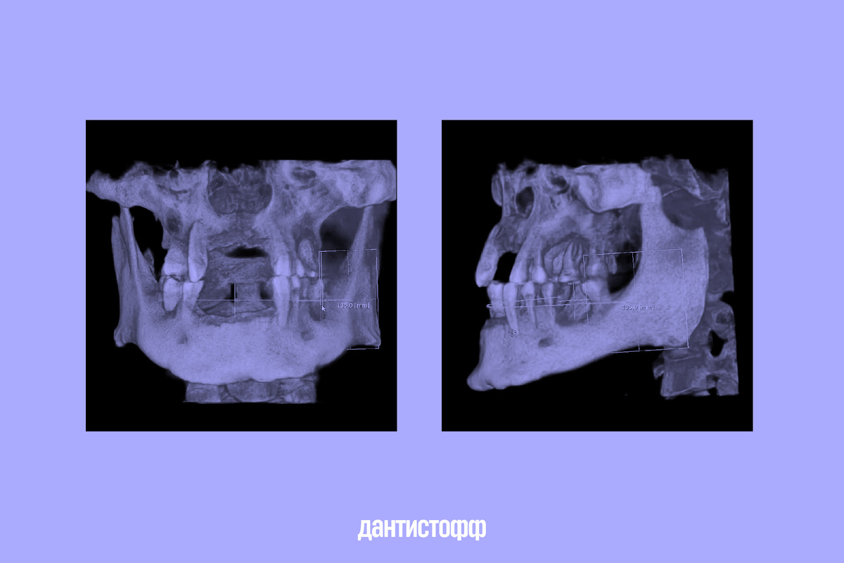 Снимки моей челюсти