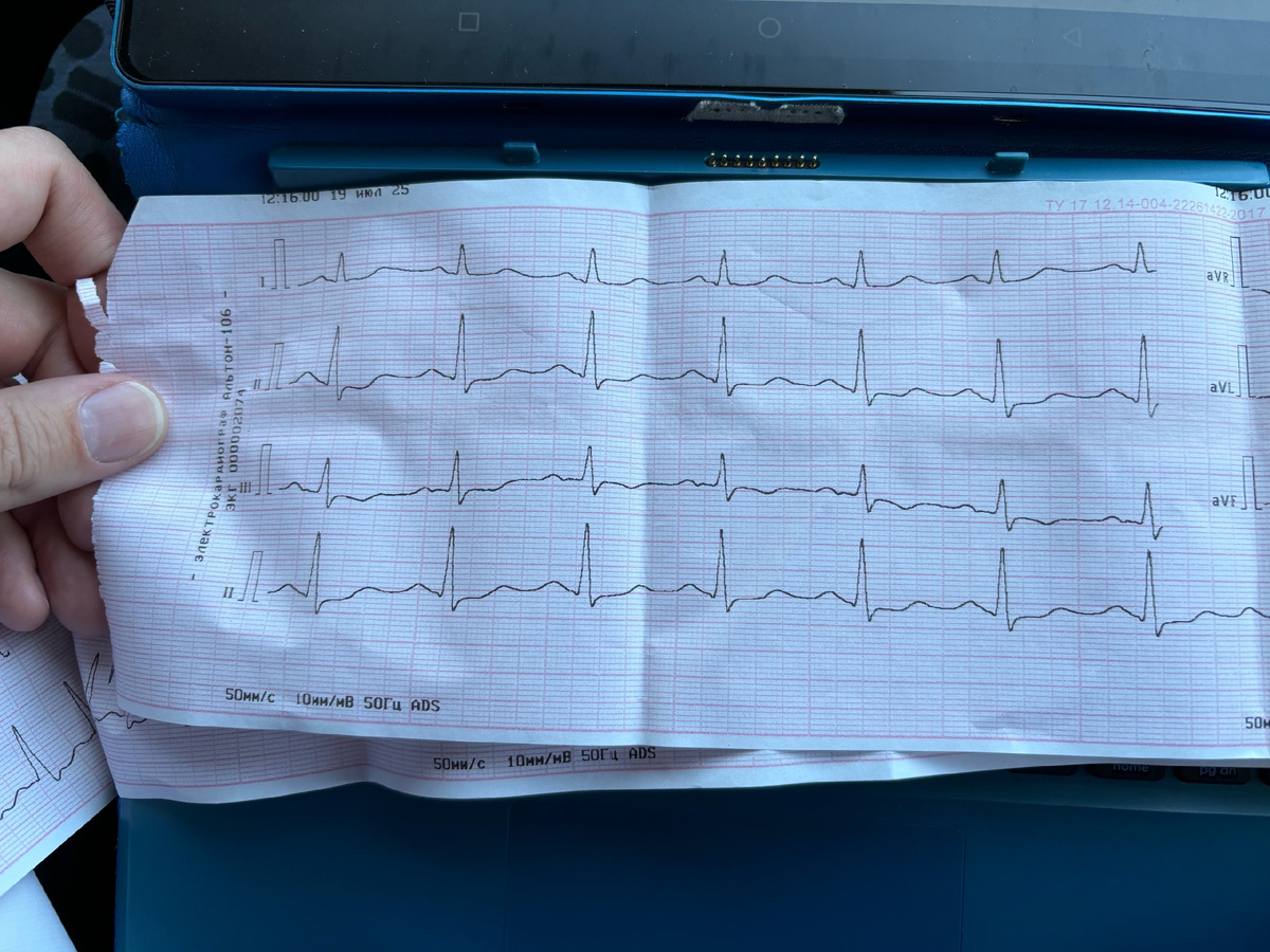 ЭКГ до, во время и после введения АТФ