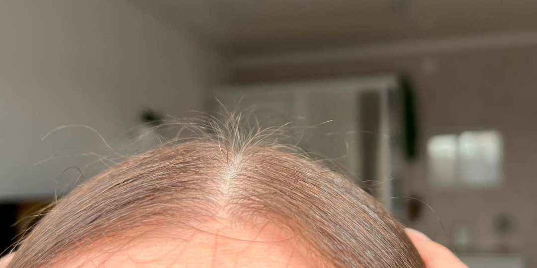 Трихолог поделился ценным советом, как спасти волосы от сильного выпадения