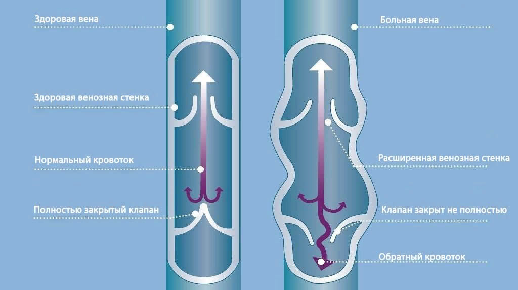 Почему вены сдаются первыми? Разговор с сосудистым хирургом о варикозе, который может подкрасться незаметно 