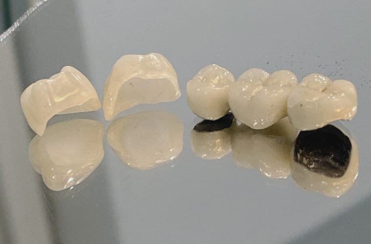 Коронки на жевательные зубы