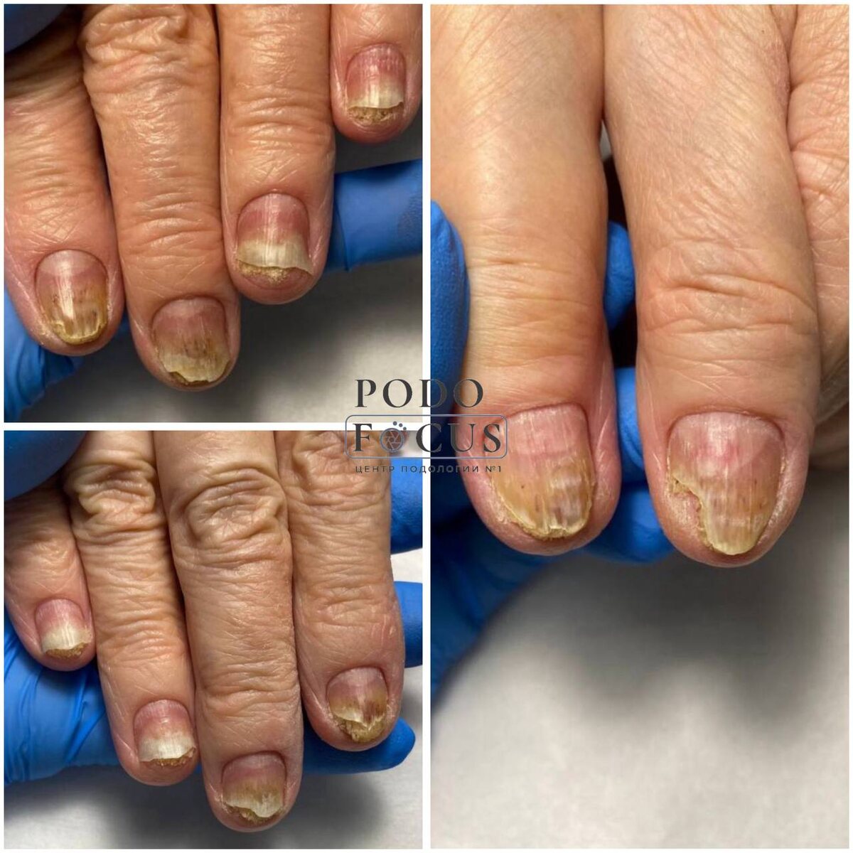 Ожог ногтевых пластин. Автор фото: Центр подологии PodoFocus