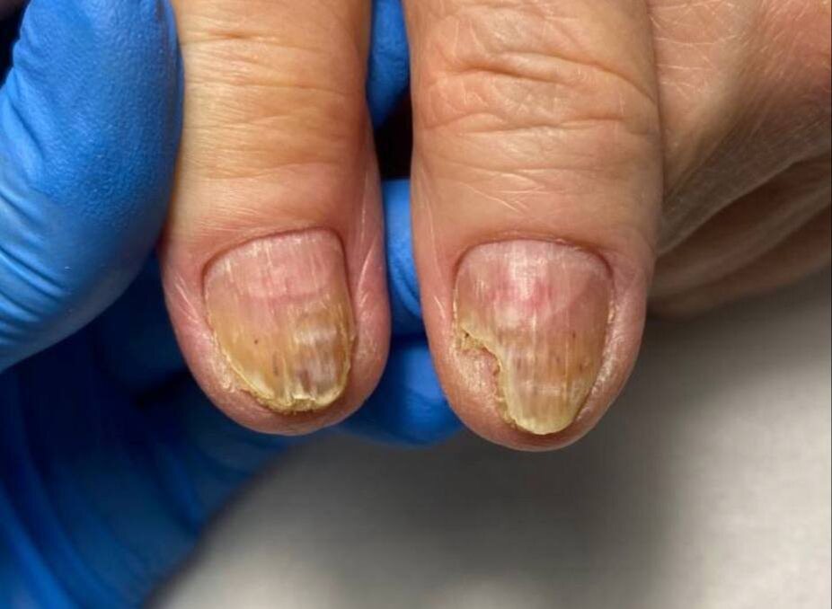 Ожог ногтевых пластин. Автор фото: Центр подологии PodoFocus