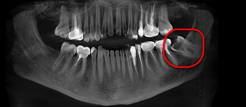 До удаления.