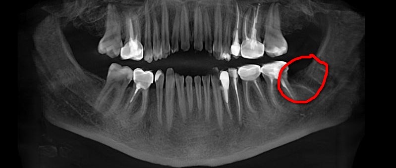 После удаления.