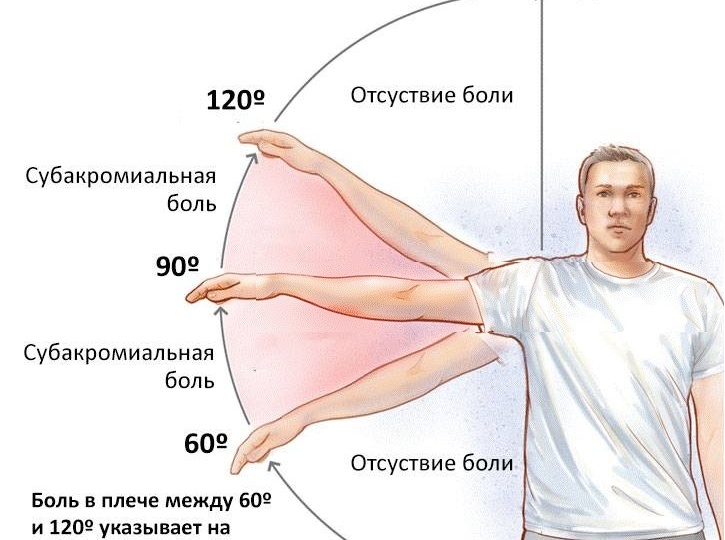 Боль в плече: разбор импинджмент-синдрома