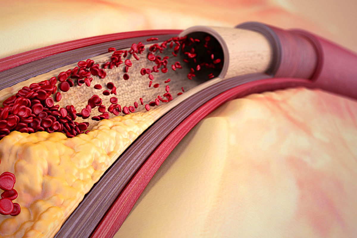 Рост бляшки провоцирует нарушение кровотока по артерии в результате чего развиваются ишемические изменения.
