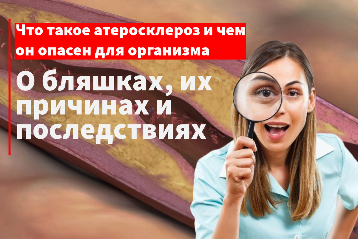 Что такое атеросклероз, почему появляются бляшки и к чему они могут привести
