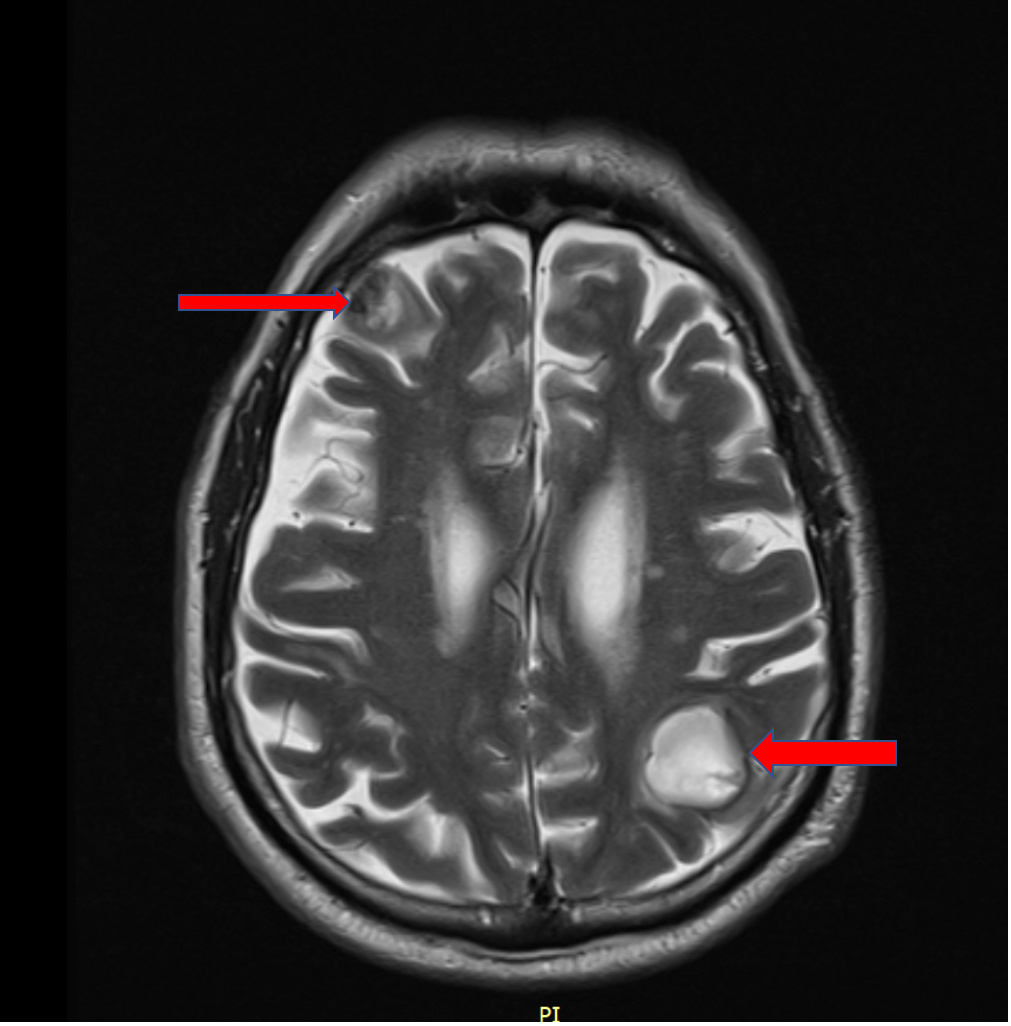 Стрелочками выделены новообразования головного мозга больших размеров