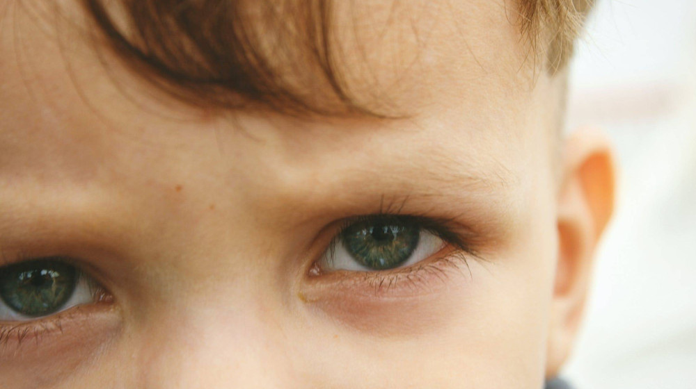    Синяки под глазами у детей: 5 неожиданных причин