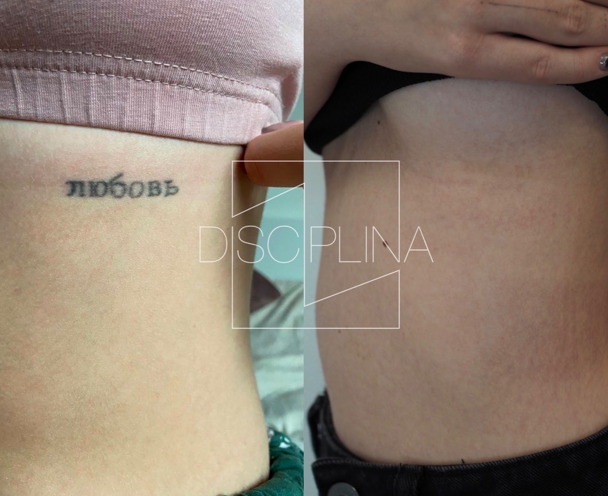 Фото «До» и «после» удаления татуировки, центр удаления тату «Дисциплина»