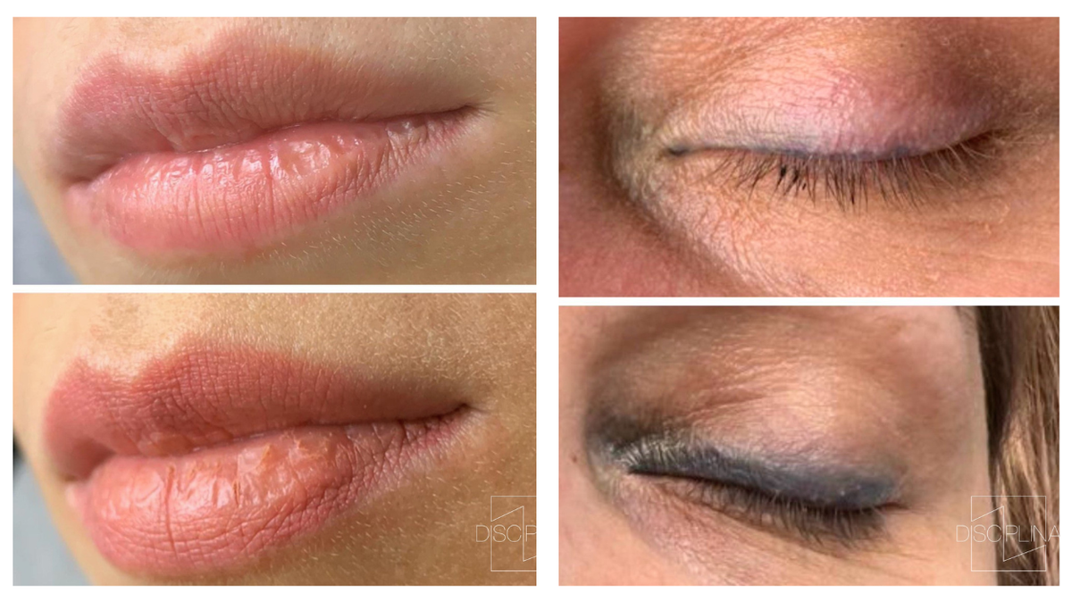 Фото «До» и «после» удаления перманентного макияжа, центр удаления тату «Дисциплина»