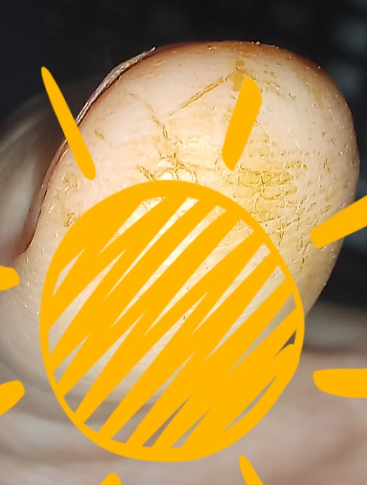 Ногти обсригла под основание