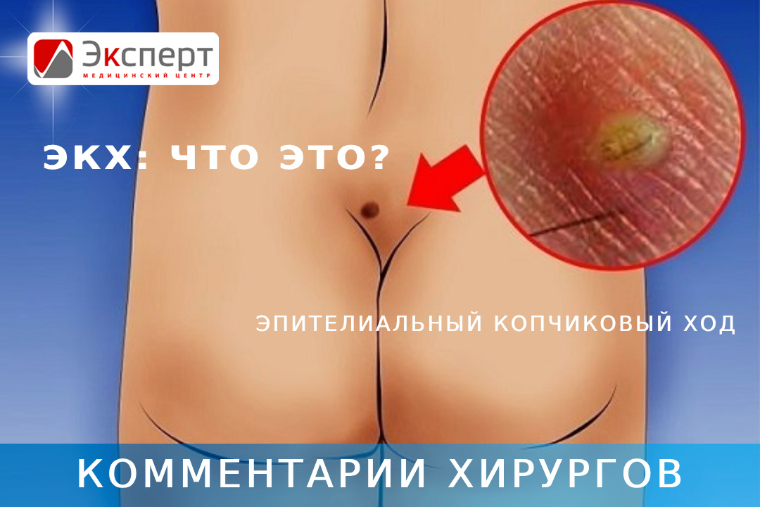 ЭКХ: определение, понятие, методы лечения