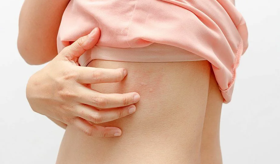 Опоясывающий лишай — привет из детства: как он связан с ветрянкой и что с ним делать