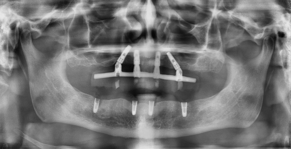 Снимок на моей первичной консультации ( лопнувший имплант 45, 42,32 - оголение на 20%)